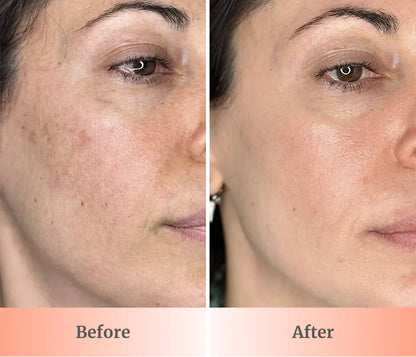Glowup™ LED Light Therapy Face Mask