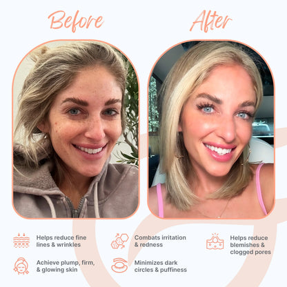 Glowup™ LED Light Therapy Face Mask